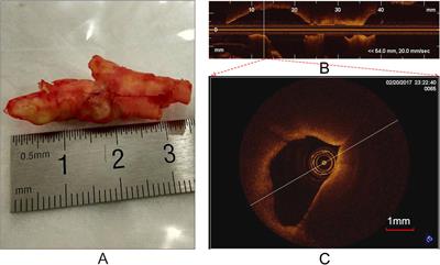 Atherosclerotic Plaque Tissue Characterization: An OCT-Based Machine Learning Algorithm With ex vivo Validation